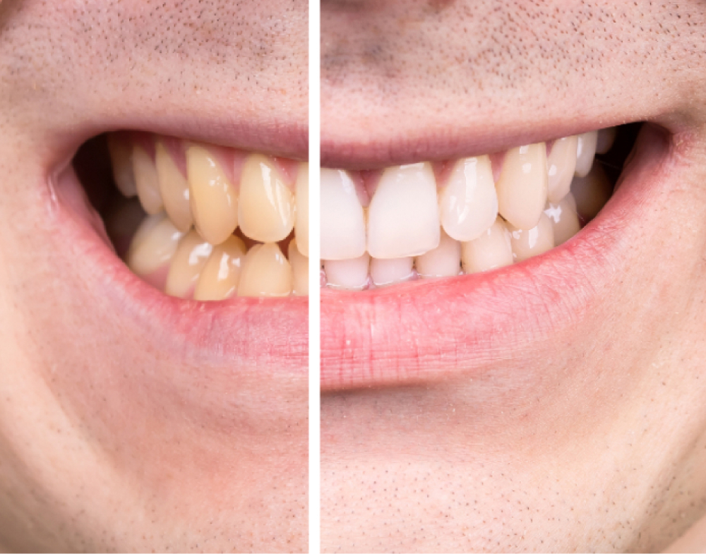 Teeth Whitening Kit 1