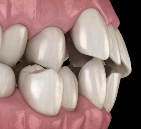 7 Ways Mouthguards Help with Clenching