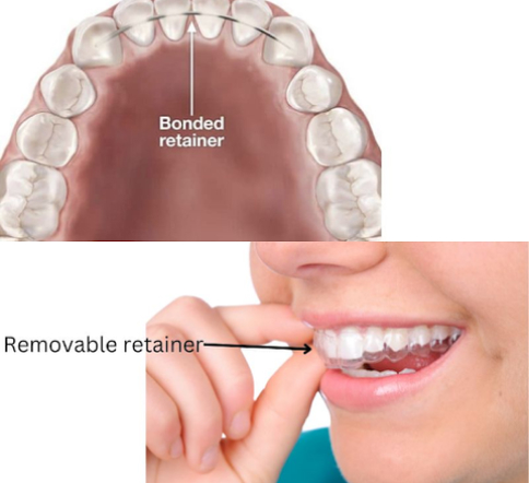 Retainers After Braces: Essential Guide to Maintaining Alignment
