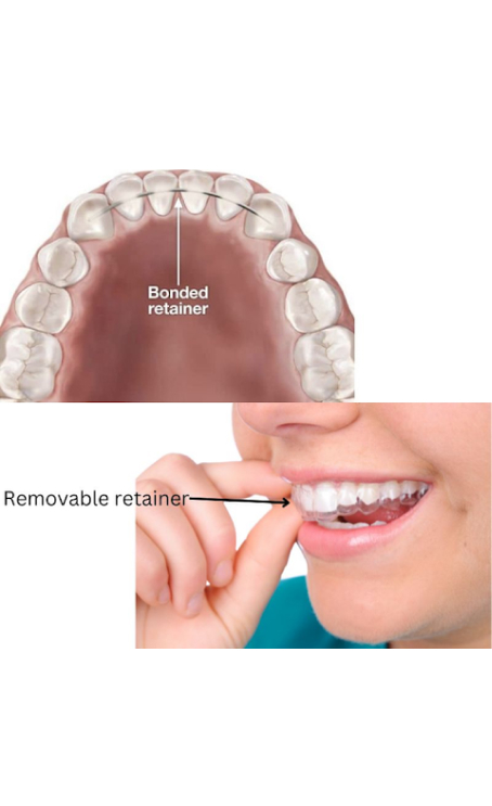 Retainers After Braces: Essential Guide to Maintaining Alignment
