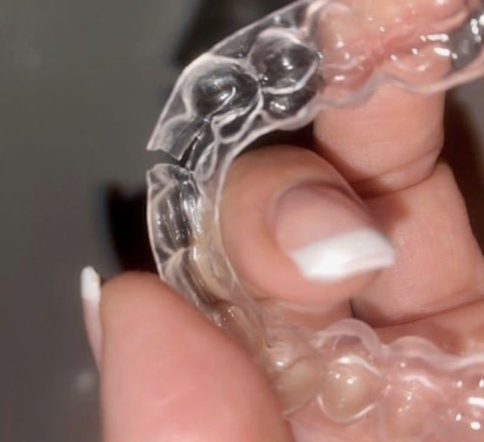 Retainers After Braces: Essential Guide to Maintaining Alignment