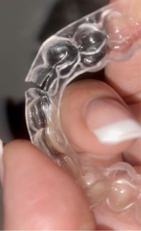 Retainers After Braces: Essential Guide to Maintaining Alignment