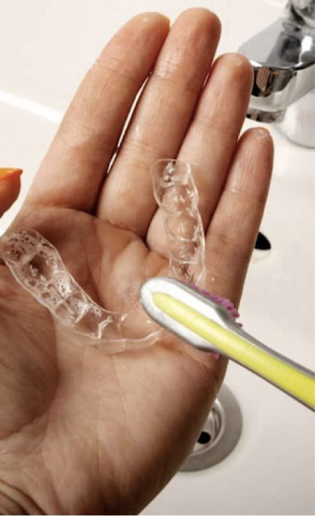 Retainers After Braces: Essential Guide to Maintaining Alignment