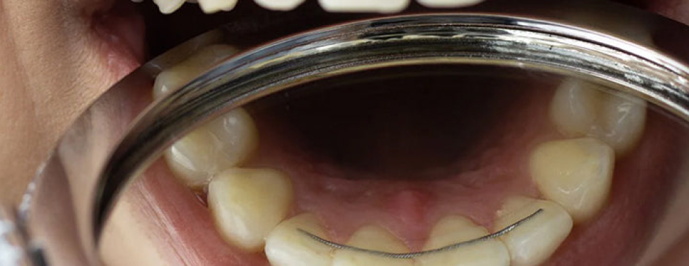 Can Your Wear A Mouthguard With a Permanent Dental Wire Behind Your Teeth?