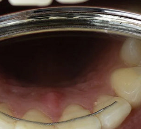 Can Your Wear A Mouthguard With a Permanent Dental Wire Behind Your Teeth?