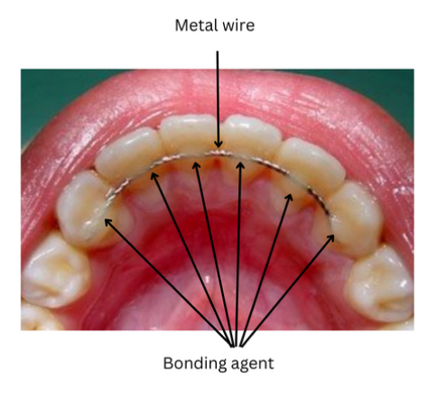 How Long do Retainers Need to be Worn? A Detailed Overview