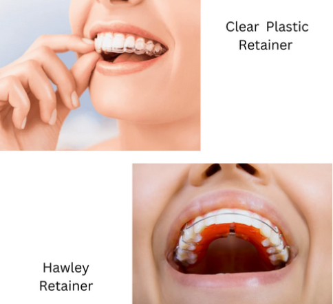 How Long do Retainers Need to be Worn? A Detailed Overview