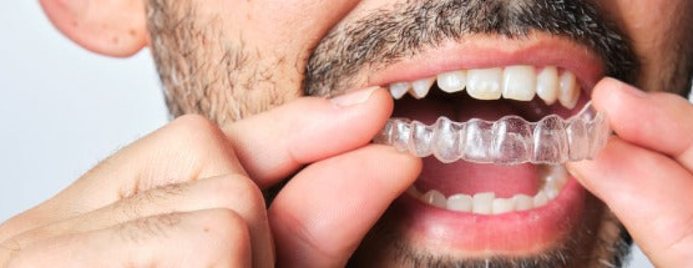 How Long do Retainers Need to be Worn? A Detailed Overview