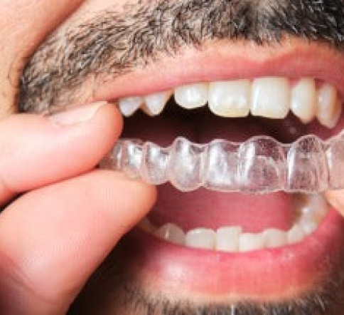 How Long do Retainers Need to be Worn? A Detailed Overview