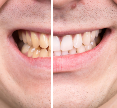 Teeth Whiteining Results