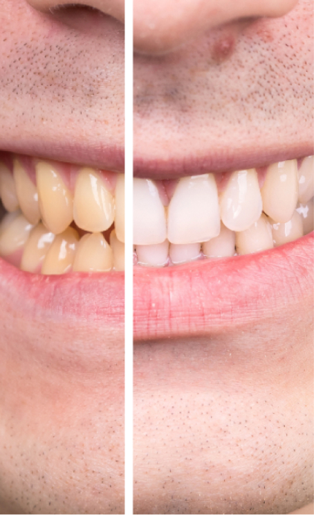 Teeth Whiteining Results